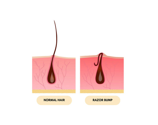 What Is A Razor Bump?